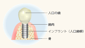 インプラント治療