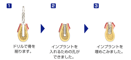 （STEP3）インプラント手術 