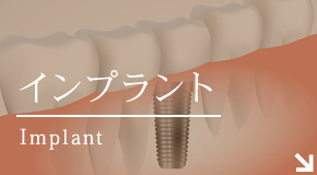 インプラントImplant